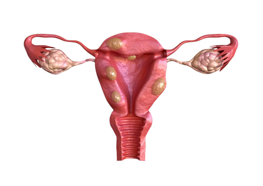 Fibroids