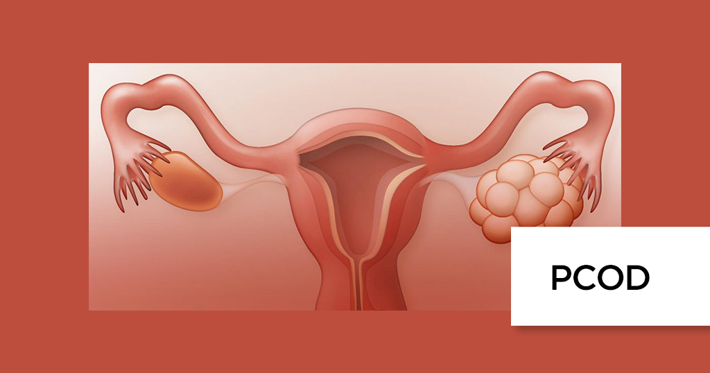 PCOD Treatment and Management